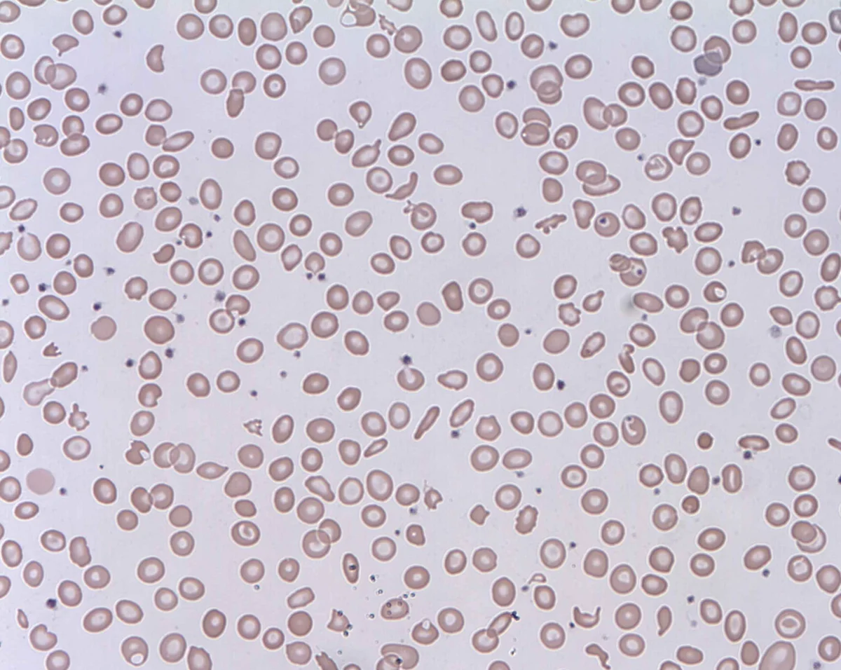 Peripheral blood smear at high power