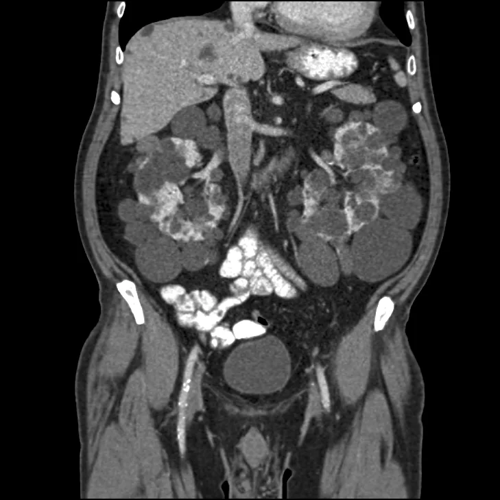 Coronal contrast-enhanced CT of the abdomen