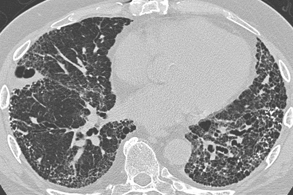 Axiale hochauflösende CT des Thorax in Höhe der Unterfelder