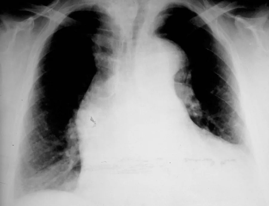 Frontal chest radiograph
