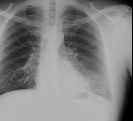 Frontal chest radiograph