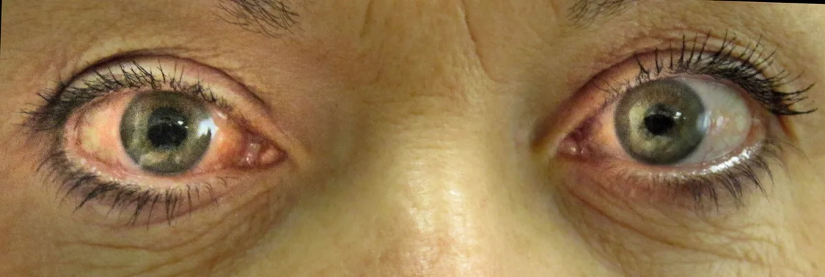 Clinical photograph of both eyes side by side