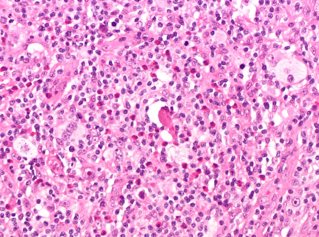 H&E-stained section of an excised lymph node