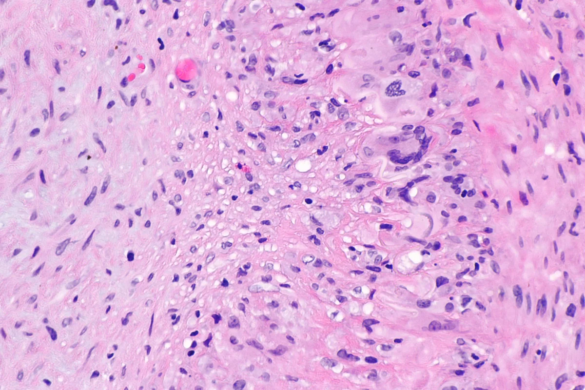 High-power H&E section through the wall of a temporal artery