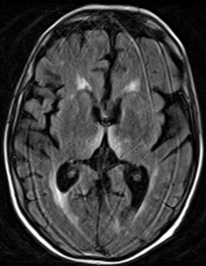 Axial FLAIR MRI of the brain
