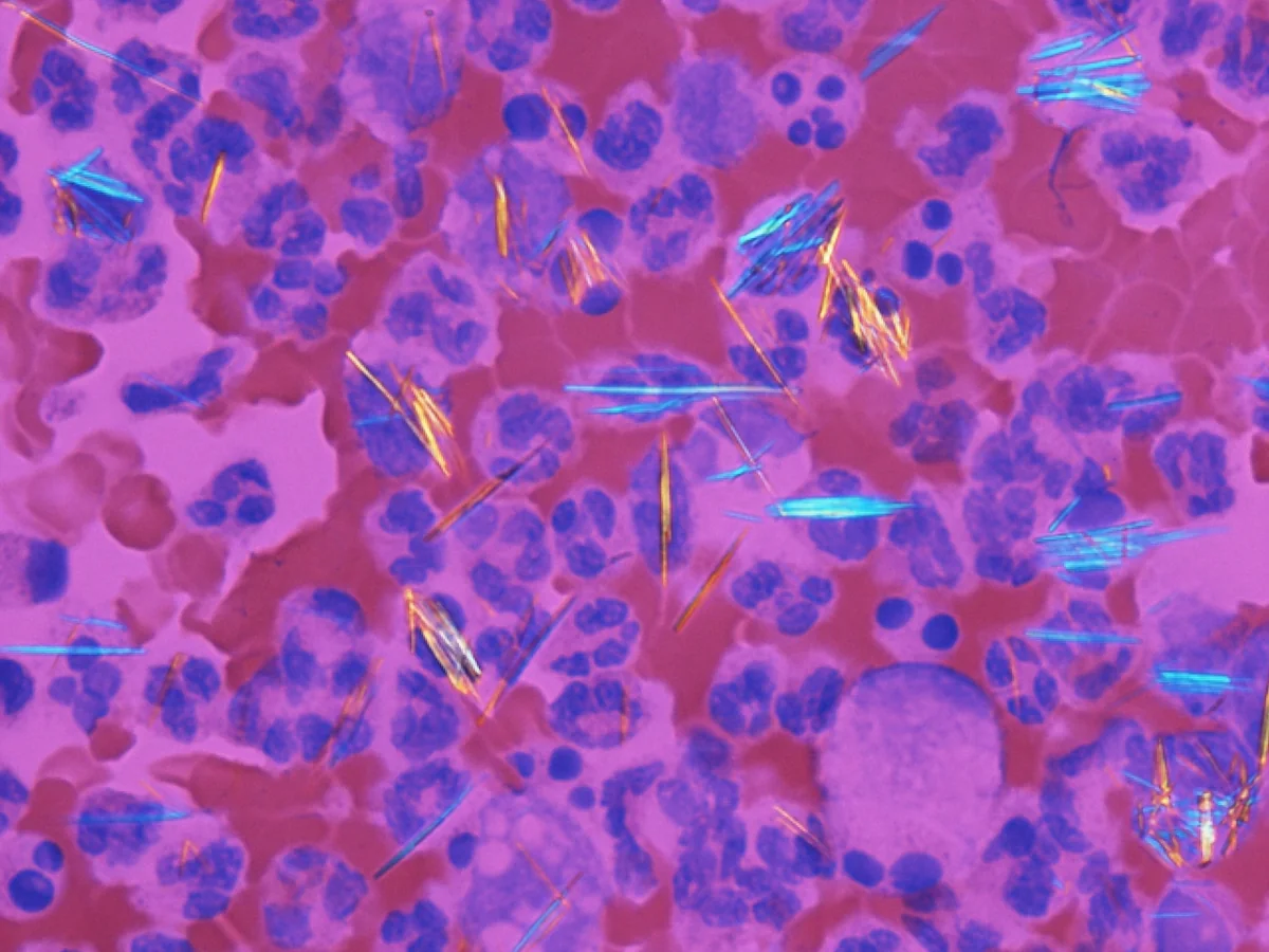 Synovial fluid under polarised light with a red compensator