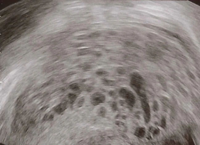 Transvaginal ultrasound image of the uterus
