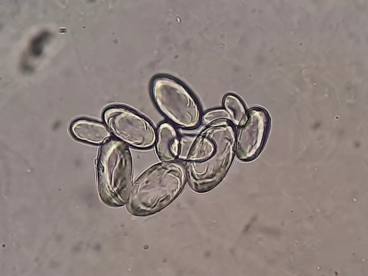Brightfield microscopy of a urine sediment preparation